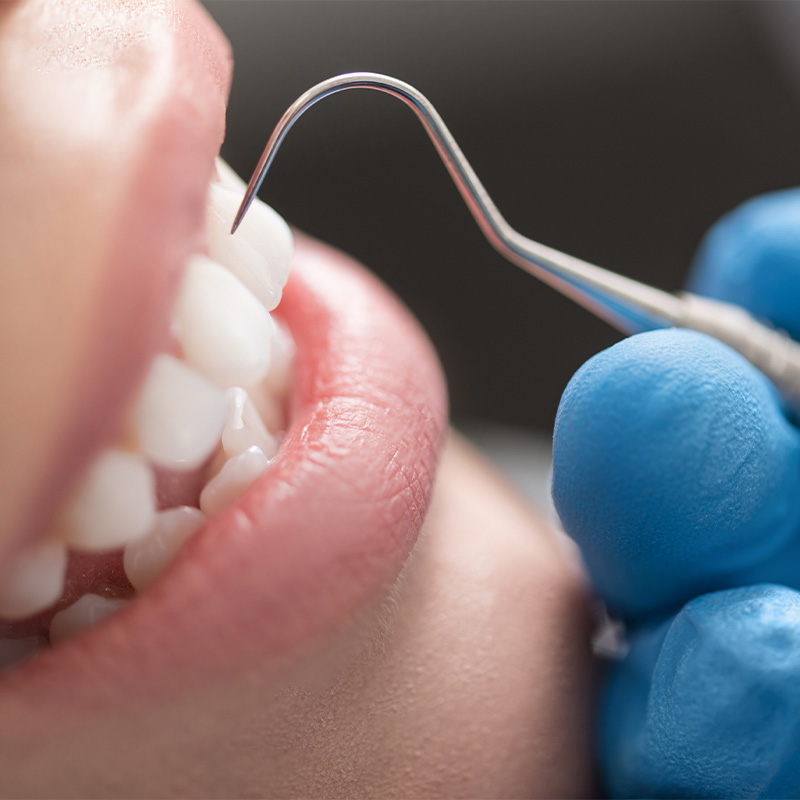 予防・クリーニング