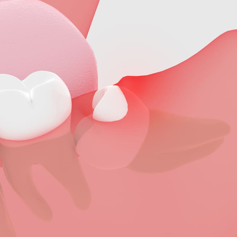 智歯周囲炎のリスク